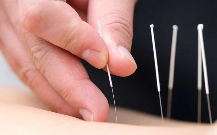 The Benefits of Acupuncture Therapy for Athletes