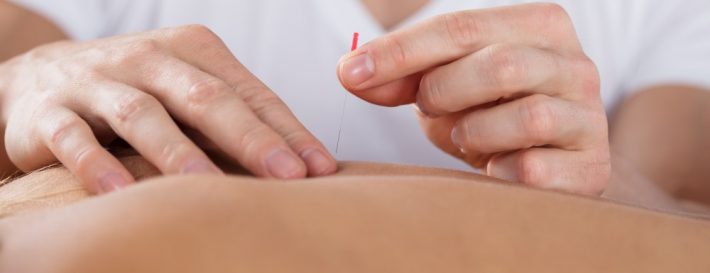 Benefits of Combining Chiropractic Care and Acupuncture