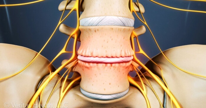 Treating Degenerative Disc Disease With Chiropractic Care