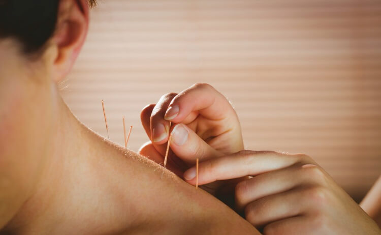 Dry Needling for Scapular Winging